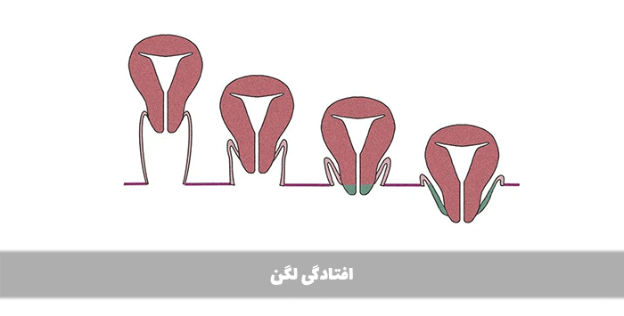 افتادگی لگن چیست