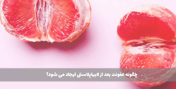 چگونه عفونت بعد از لابیاپلاستی ایجاد می شود؟