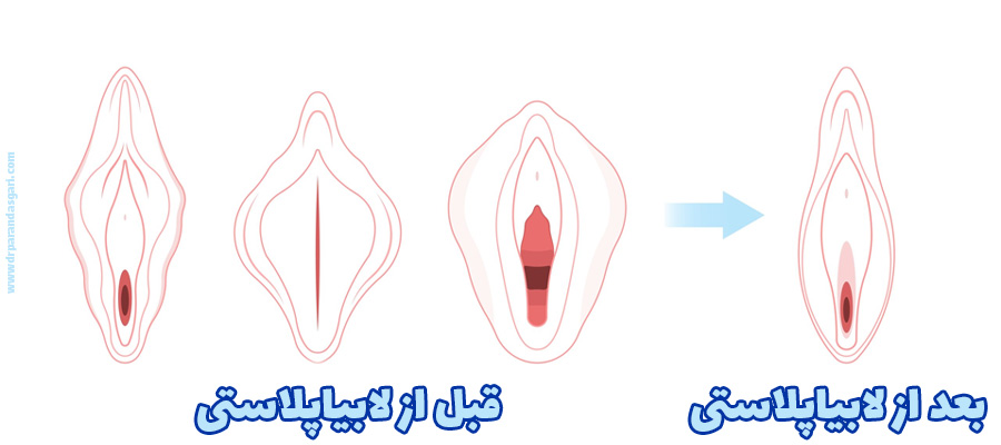 عکس قبل و بعد از عمل لابیاپلاستی