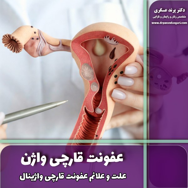 عفونت قارچی واژن