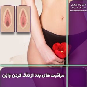 مراقبت های بعد از تنگ کردن واژن