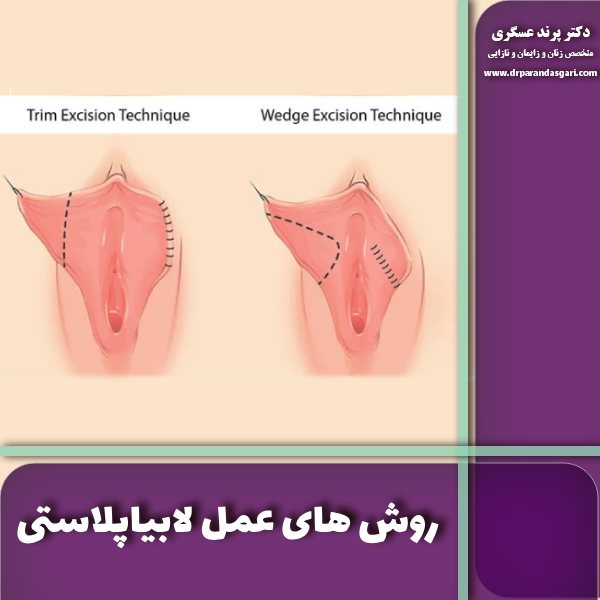 بهترین روش جراحی لابیاپلاستی چیست؟ انواع روش های عمل لابیاپلاستی