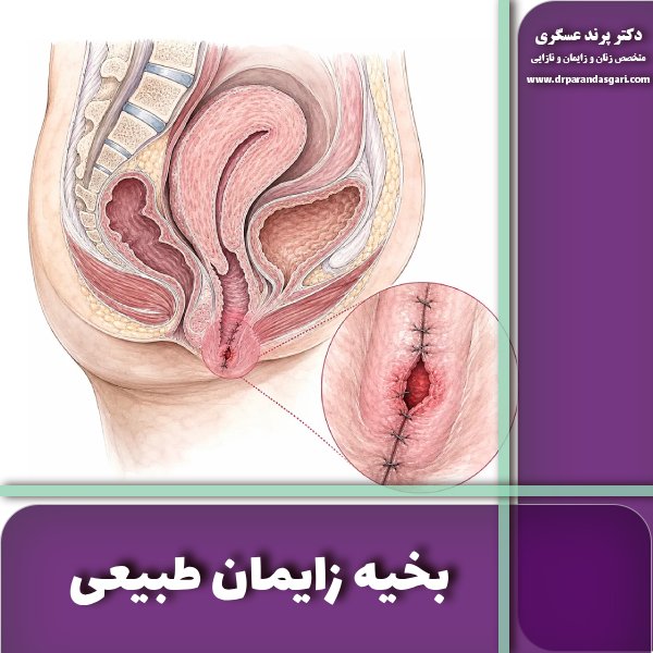 بخیه زایمان طبیعی